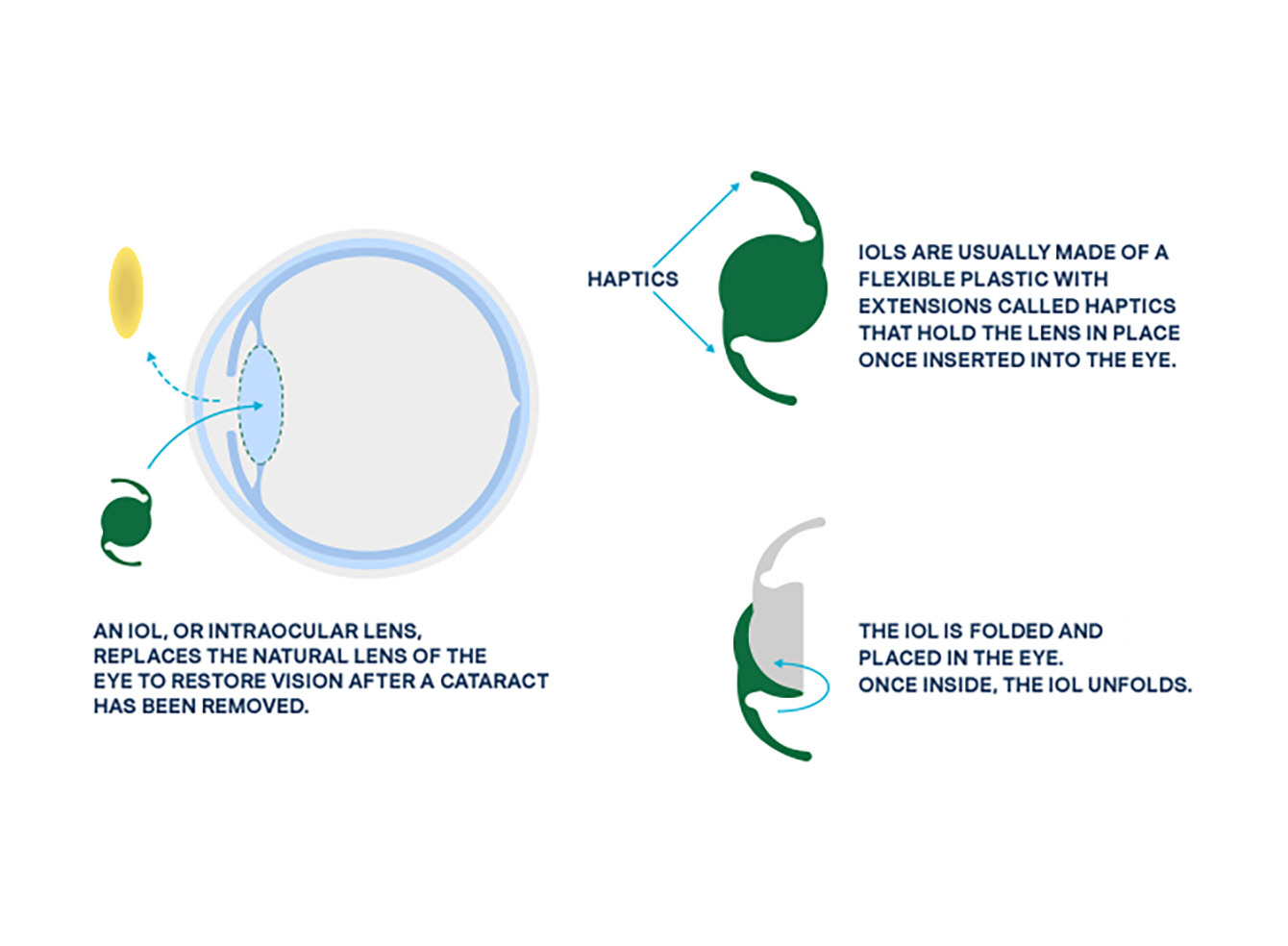 Visual of the eye showing how an intraocular lens (IOL) replaces the natural lens during cataract surgery