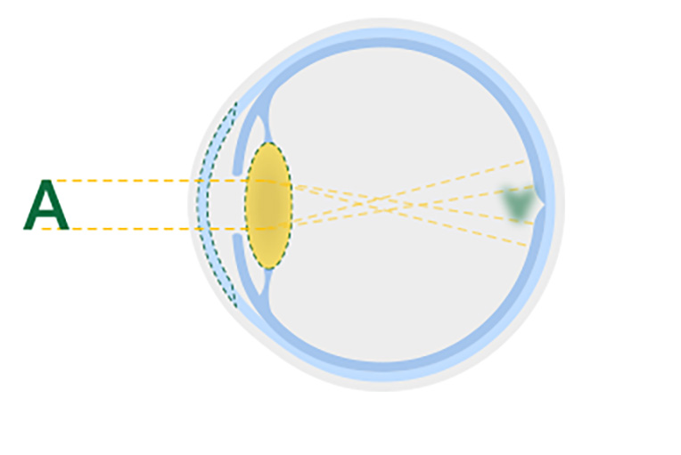 Diagram of a cloudy lens from an eye cataract